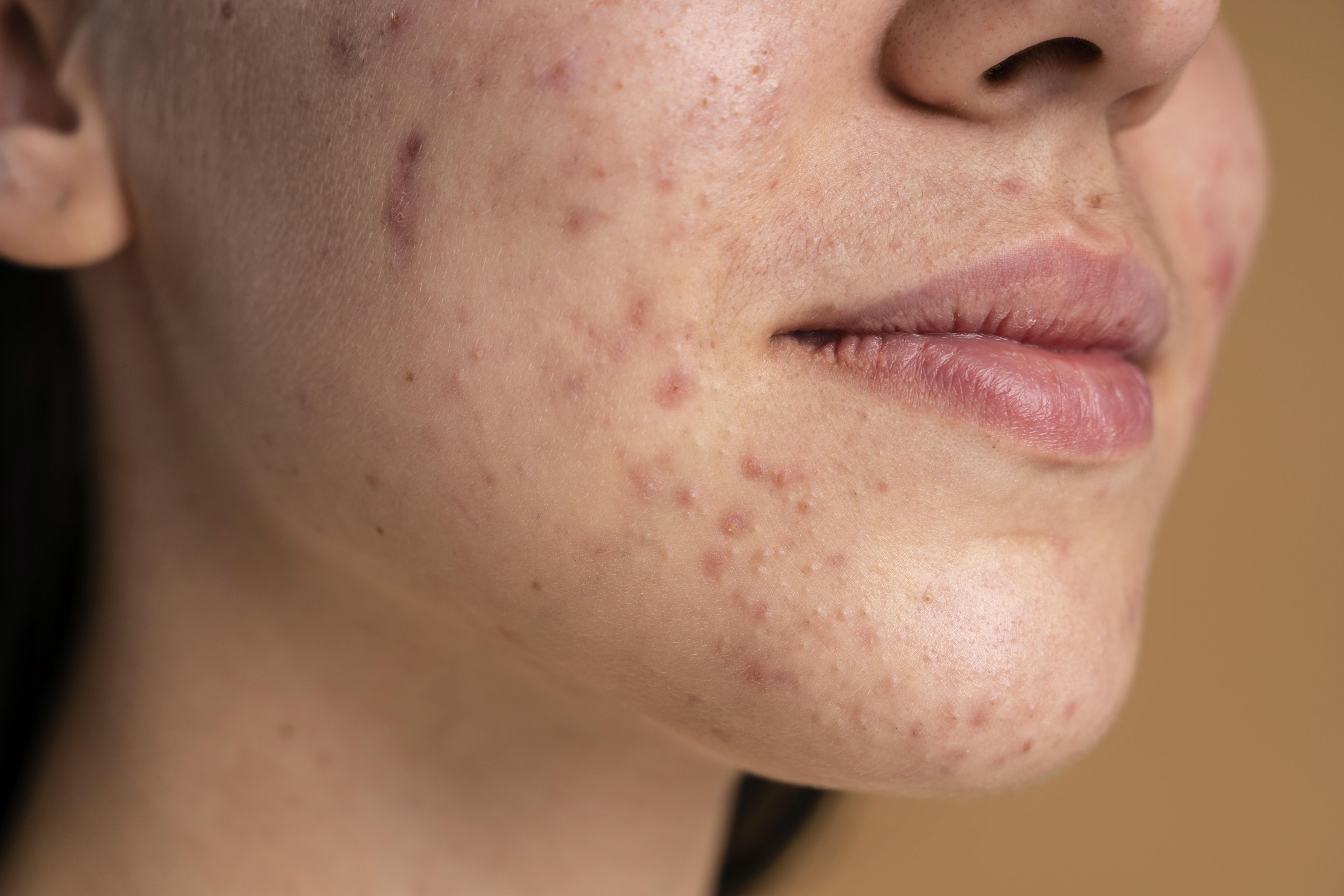 Melasma